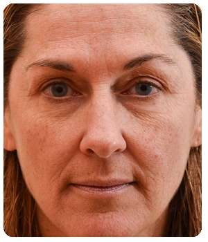 Состояние кожи лица до применения крема Caviarlift.