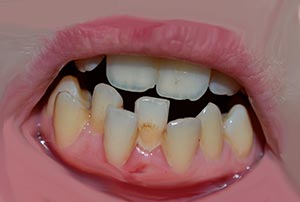 Кривые зубы причины