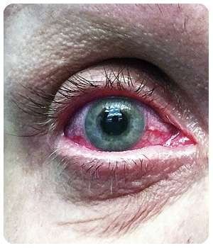 Состояние глаза до применения препарата Оптофрин.