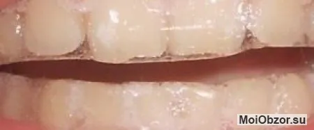 Отбеливающие полоски на зубах